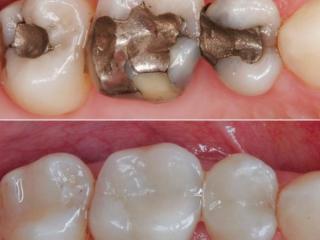 Amalgam Replacement
