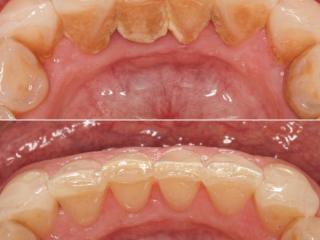 Hygiene Treatment