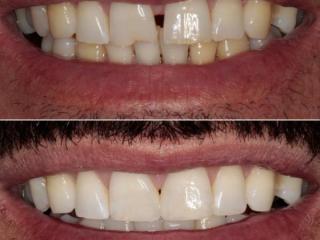 Whitening & Bonding