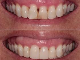 Bonding & Whitening